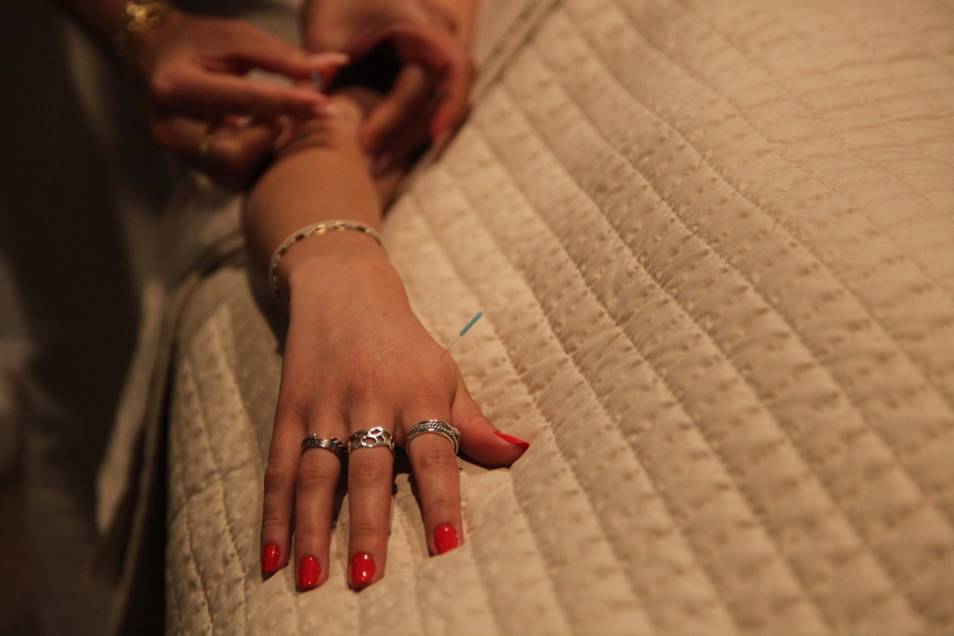 Fine acupuncture needles applied to a hand